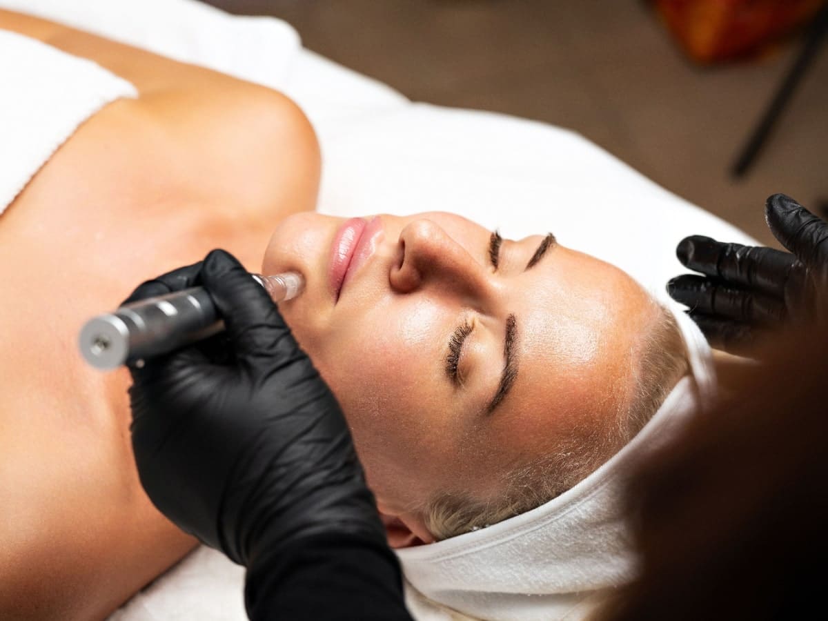 Microneedling