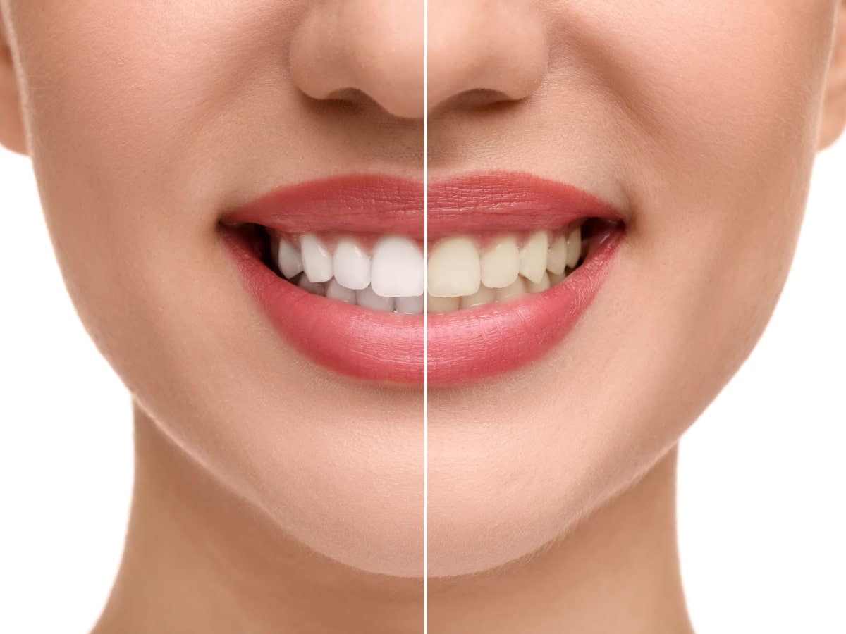 Teeth Whitening